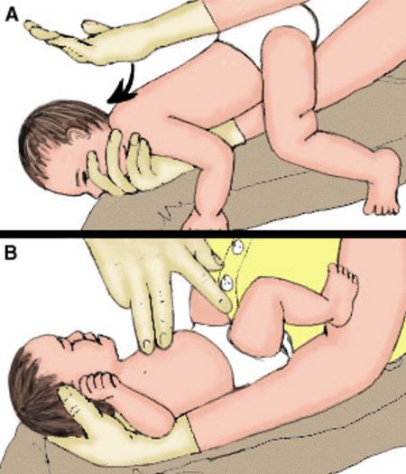 Cách sơ cứu bé bị hóc dị vật