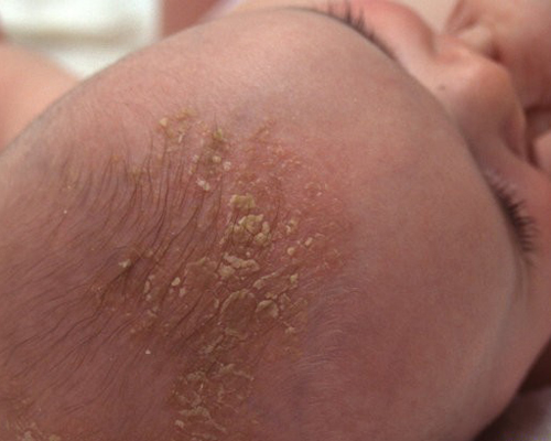 Làm sao để trị “cứt trâu” cho bé sơ sinh?