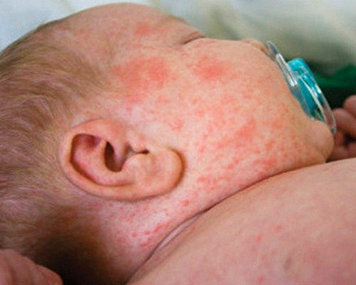 Sởi – Quai bị - Rubella