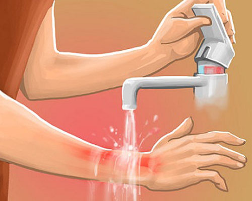 Xử trí khi bé bị bỏng