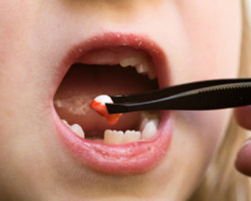 Khi nào không nên tự nhổ răng cho bé?